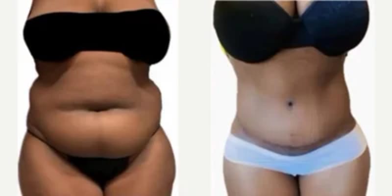 Mommy Makeover procedure image