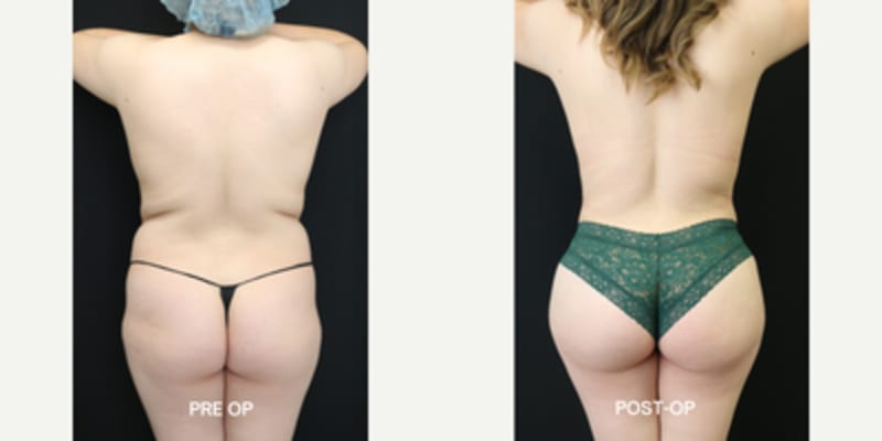 Brazilian Butt Lift (BBL) procedure image