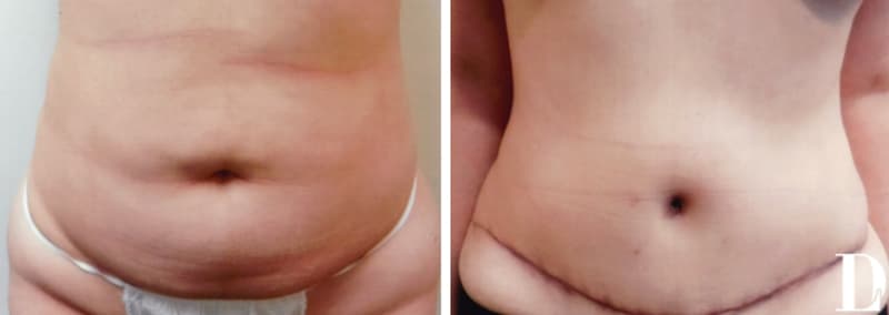 Tummy Tuck (Abdominoplasty) procedure image