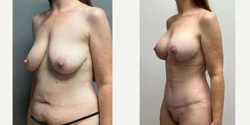 Mommy Makeover procedure image