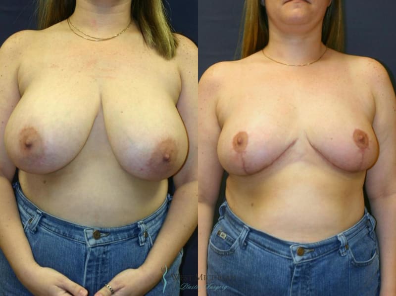 Breast Augmentation procedure image