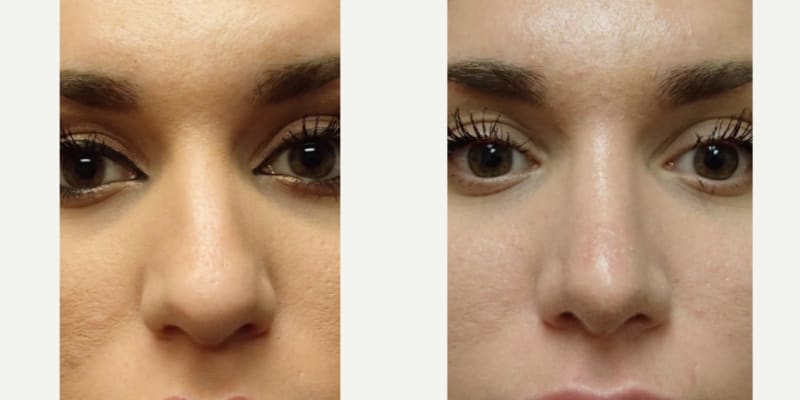 Rhinoplasty (Nose Job) procedure image