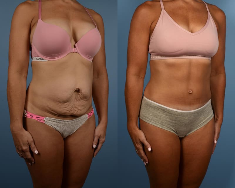 Tummy Tuck (Abdominoplasty) procedure image