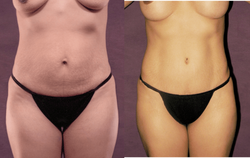 Mommy Makeover procedure image