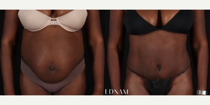 Breast Augmentation procedure image