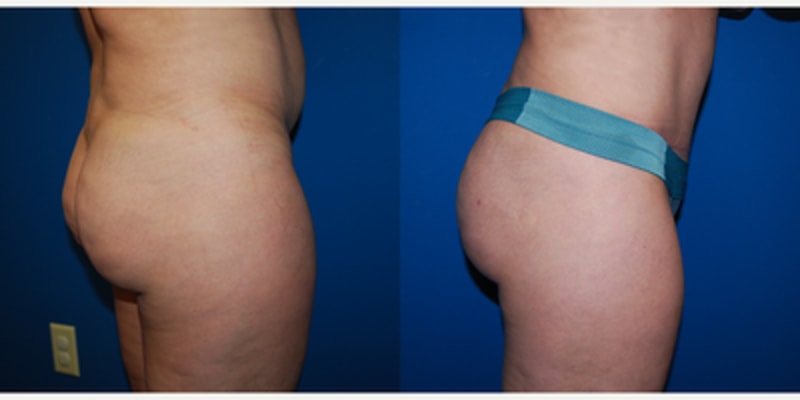 Brazilian Butt Lift (BBL) procedure image