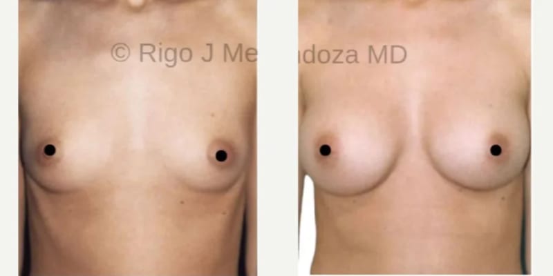 Mommy Makeover procedure image