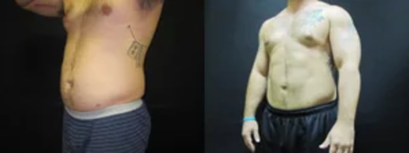 Body Lift procedure image