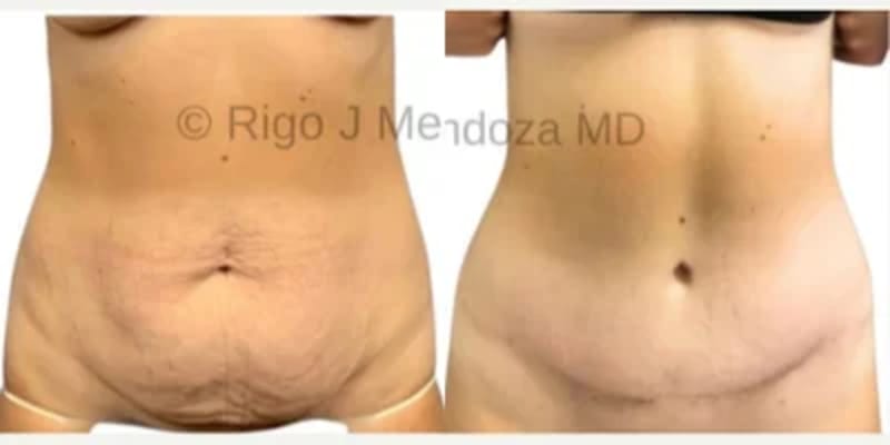 Tummy Tuck (Abdominoplasty) procedure image