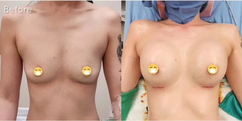 Breast Augmentation procedure image