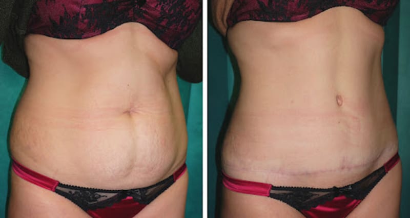 Mommy Makeover procedure image