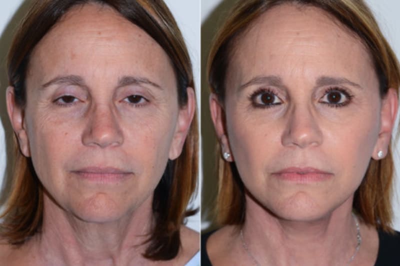 Rhinoplasty (Nose Job) procedure image