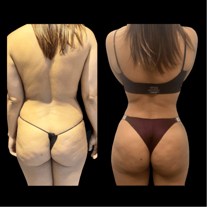 Brazilian Butt Lift (BBL) procedure image