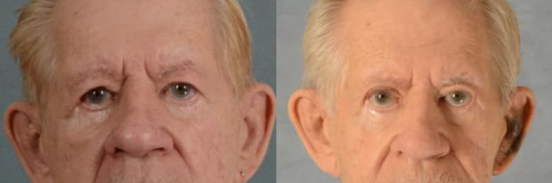 Eyelid Surgery (Blepharoplasty) procedure image