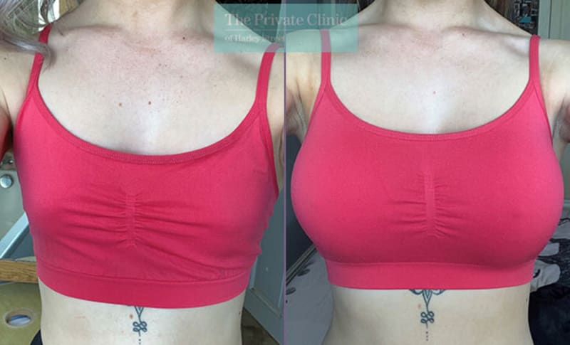 Breast Augmentation procedure image