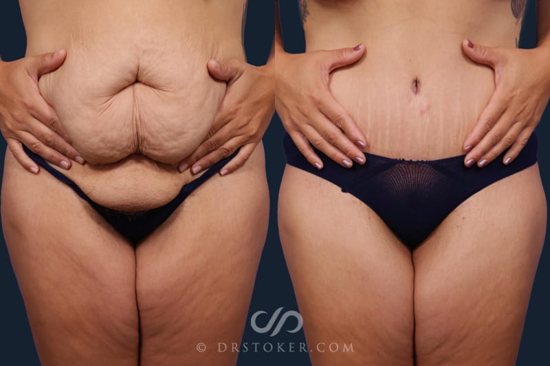 Tummy Tuck (Abdominoplasty) procedure image