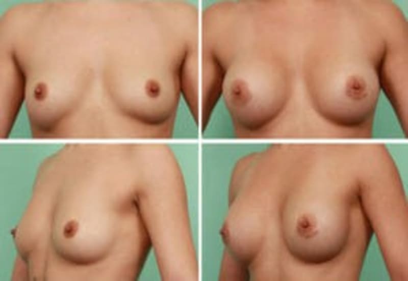 Liposuction procedure image