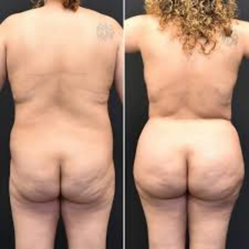 Brazilian Butt Lift (BBL) procedure image