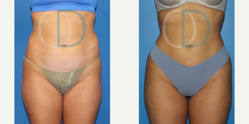 Tummy Tuck (Abdominoplasty) procedure image