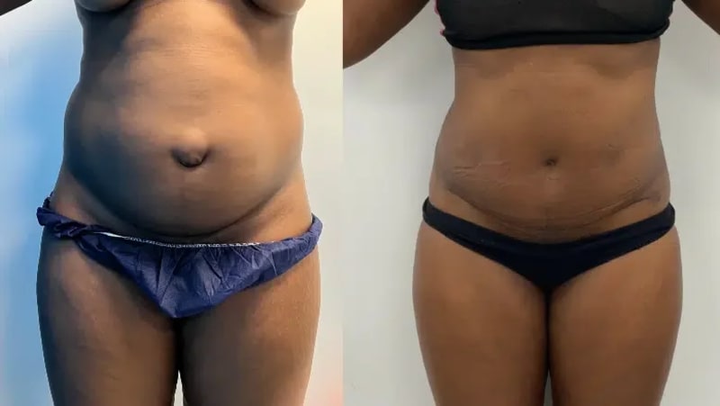 Liposuction procedure image
