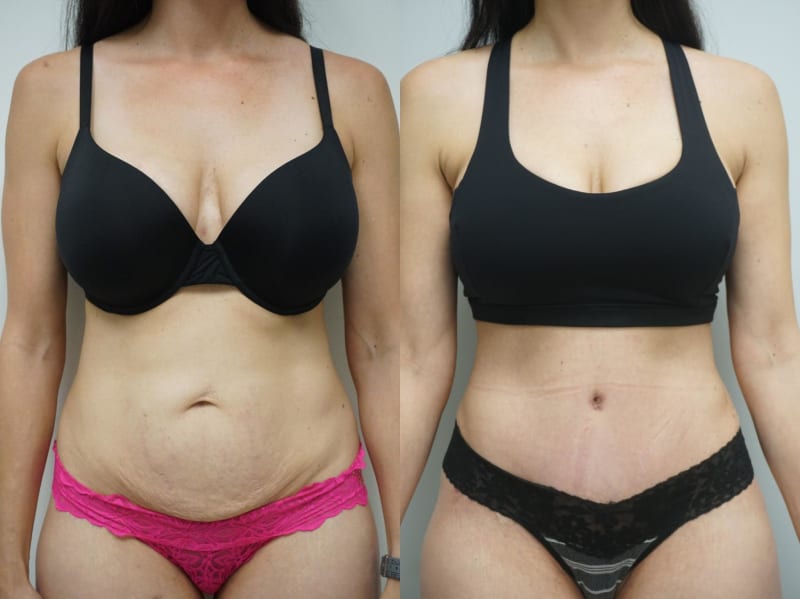 Liposuction procedure image