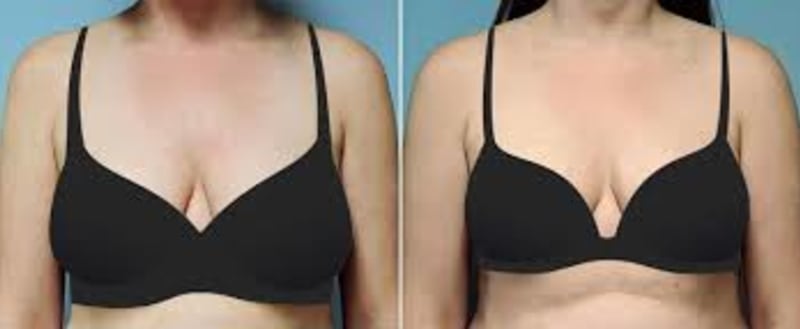 Mommy Makeover procedure image