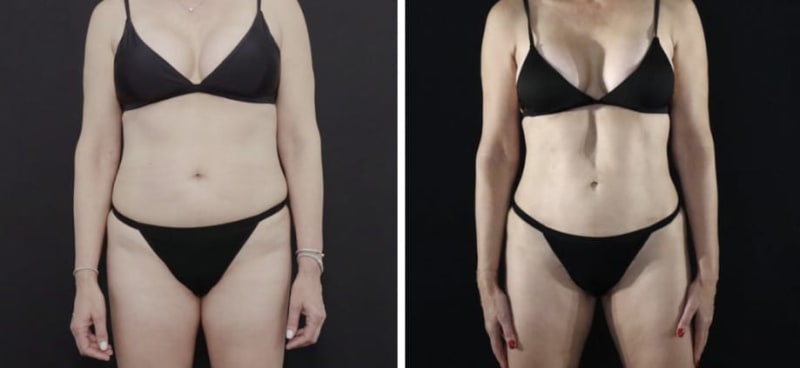 Liposuction procedure image