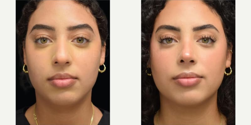 Rhinoplasty (Nose Job) procedure image