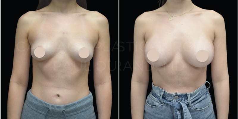 Breast Augmentation procedure image