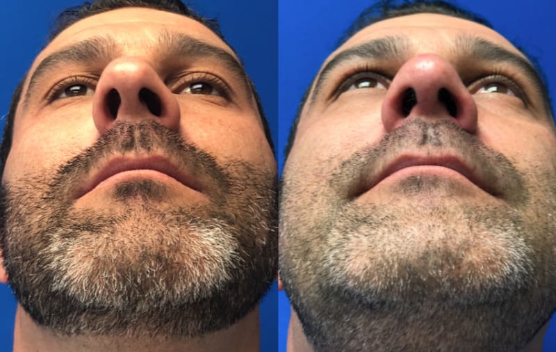 Rhinoplasty (Nose Job) procedure image