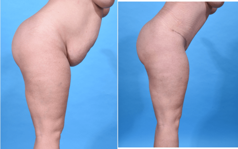 Tummy Tuck (Abdominoplasty) procedure image