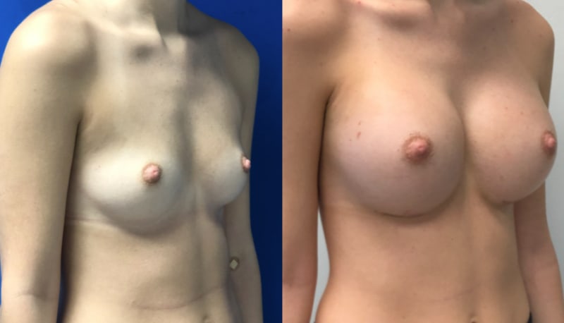 Breast Augmentation procedure image