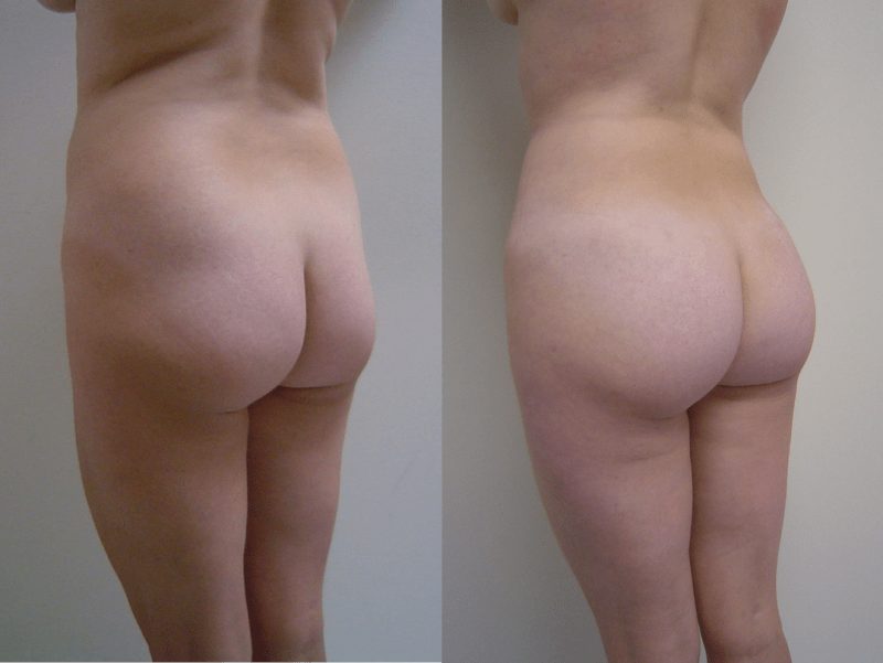 Brazilian Butt Lift (BBL) procedure image