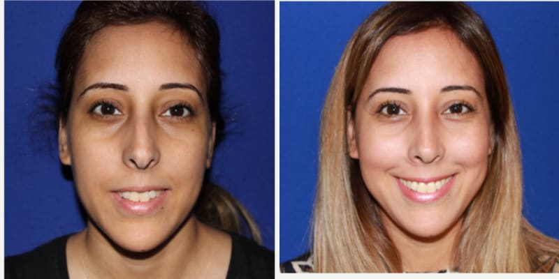 Rhinoplasty (Nose Job) procedure image