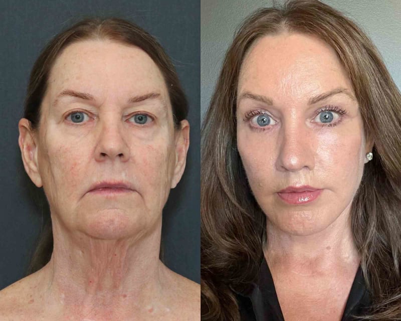Facelift procedure image