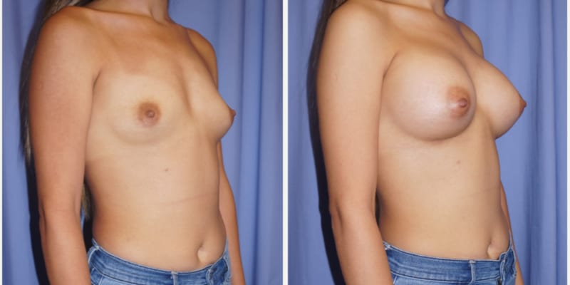 Breast Implants (Saline/Silicone) procedure image