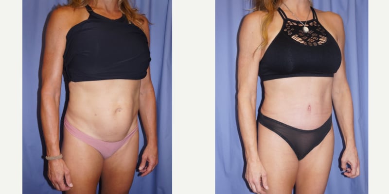 Tummy Tuck (Abdominoplasty) procedure image