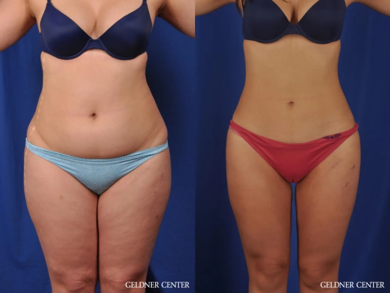 Liposuction procedure image