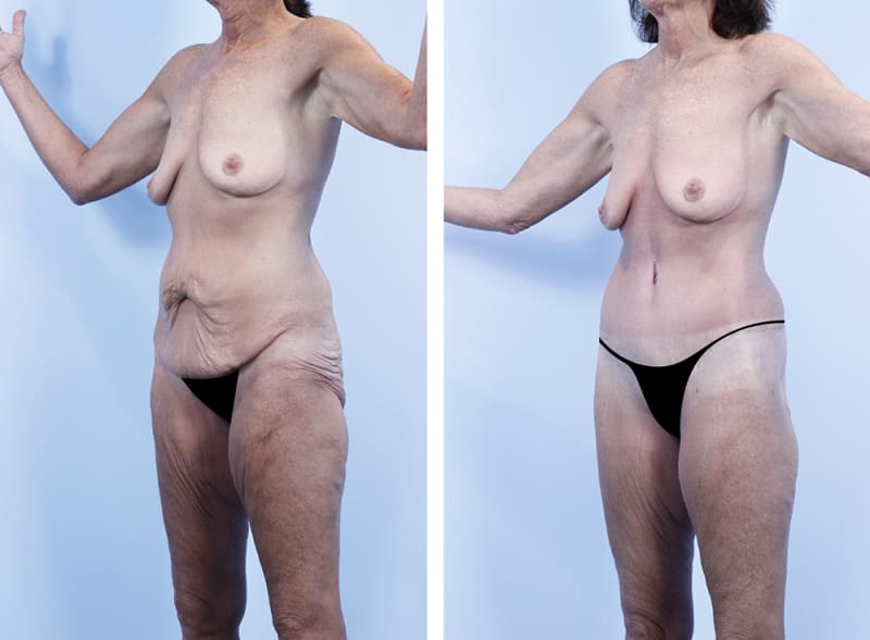 Body Lift procedure image