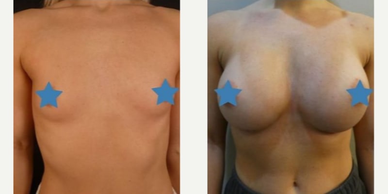 Breast Augmentation procedure image
