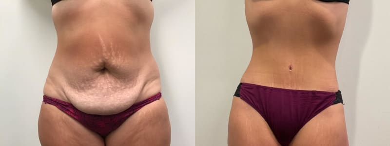 Tummy Tuck (Abdominoplasty) procedure image