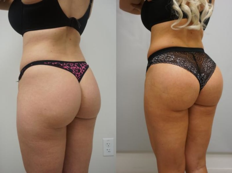 Brazilian Butt Lift (BBL) procedure image