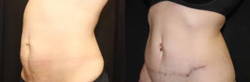 Mommy Makeover procedure image