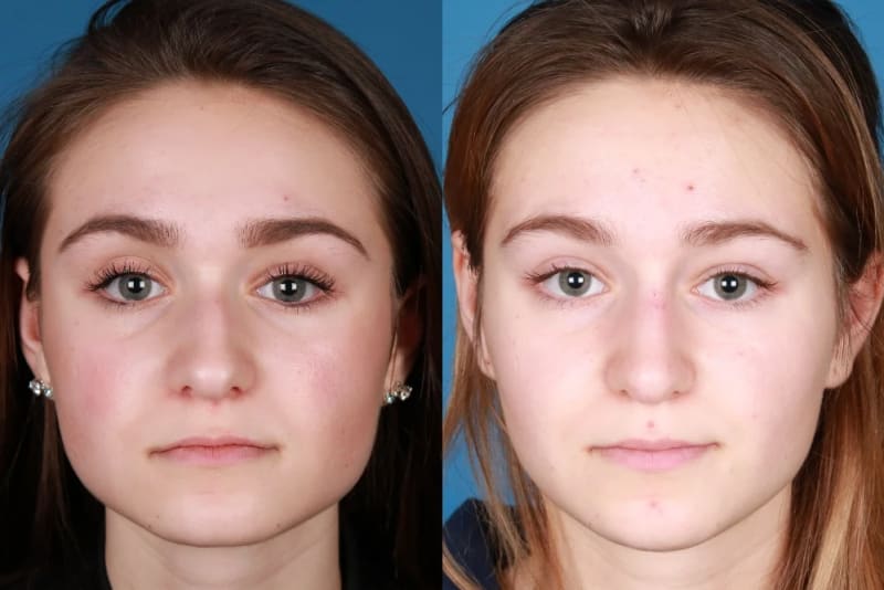 Fillers & Injectables (e.g. Botox, Juvederm) procedure image