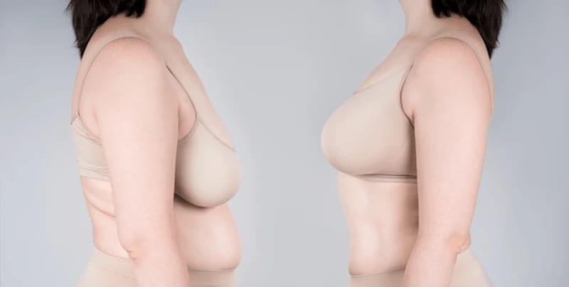 Breast Augmentation with Lift procedure image