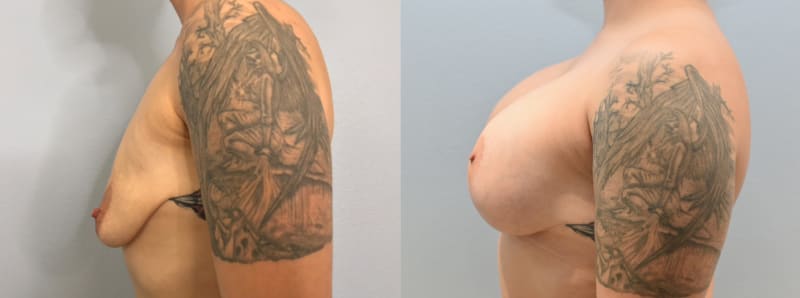 Breast Augmentation procedure image