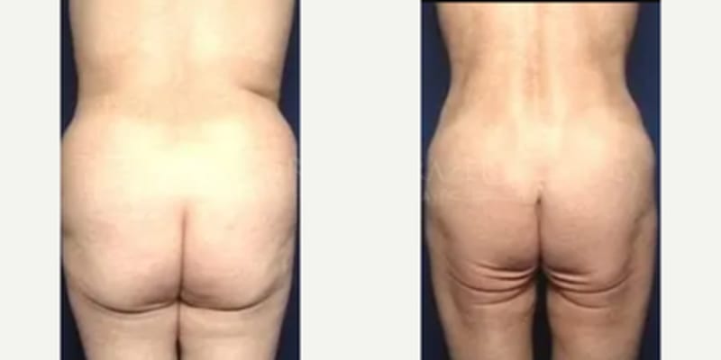 Mommy Makeover procedure image