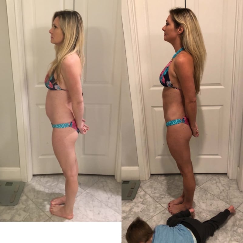 Tummy Tuck (Abdominoplasty) procedure image