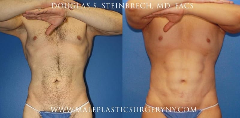 Body Lift procedure image