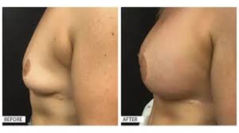 Breast Augmentation procedure image